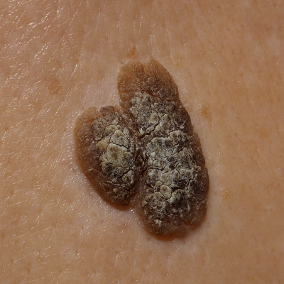 Queratosis Seborreica